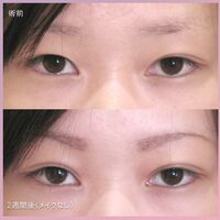 画像1373：LS法ダブル (ロングプラン)