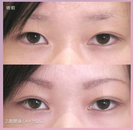 LS法ダブル(ロングプラン)