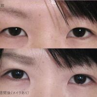 画像1376：LS法ダブル (ロングプラン)