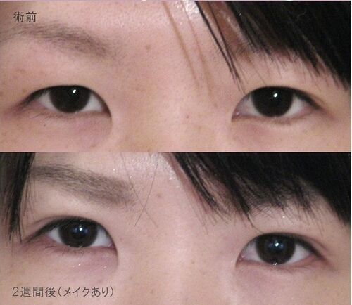 LS法シングル(ロングプラン)