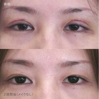 画像1382：LS法ダブル (ロングプラン)