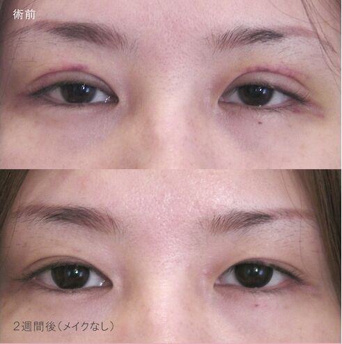 LS法ダブル(ロングプラン)＋他院抜糸