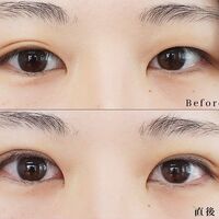 画像1390：LS法ダブル (ロングプラン)