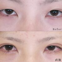 画像1407：LS法ダブル (ロングプラン)