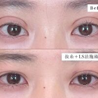 画像1428：LS法ダブル (ロングプラン)