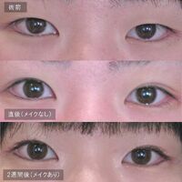 画像1434：LS法ダブル (ロングプラン)