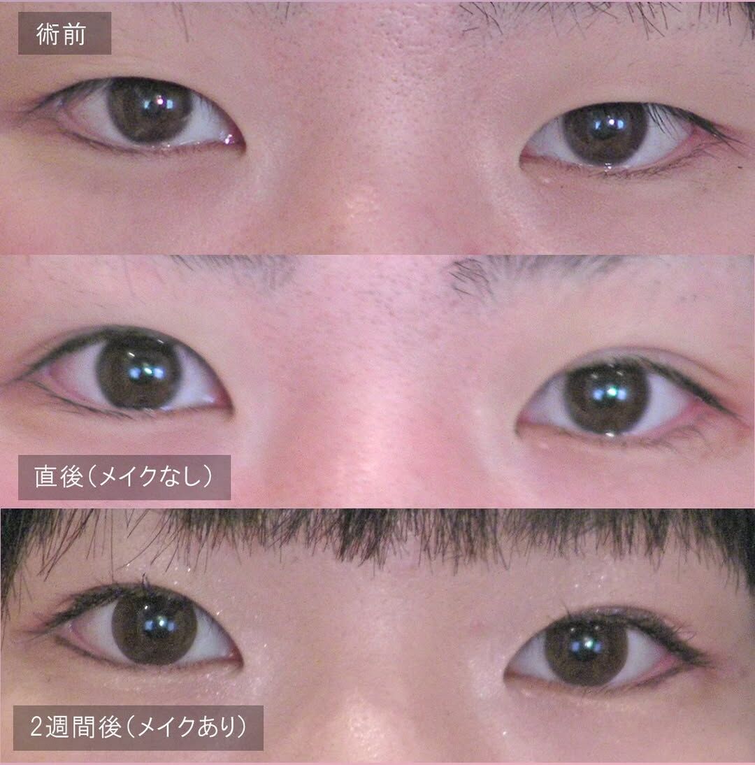 LS法ダブル(ロングプラン)
