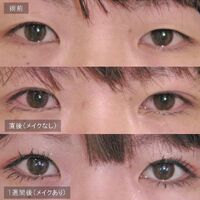 画像1437：LS法ダブル (ロングプラン)