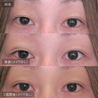 画像1440：LS法ダブル (ロングプラン)