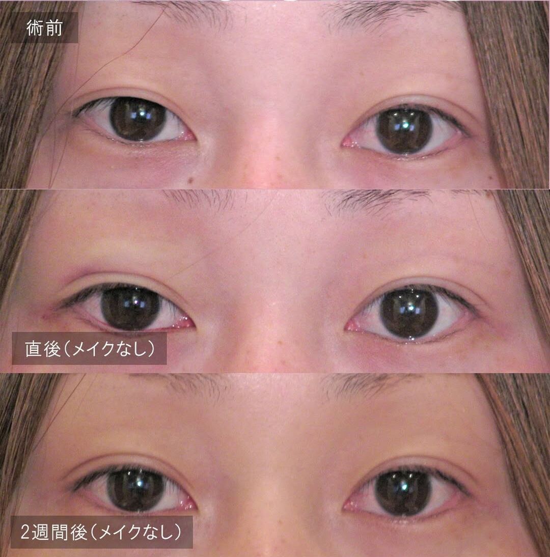 LS法ダブル(ロングプラン)