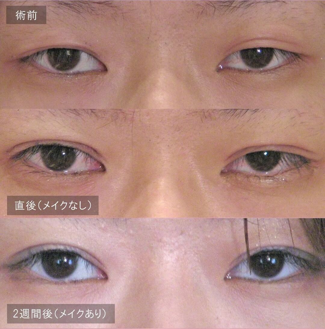 LS法ダブル(ロングプラン)