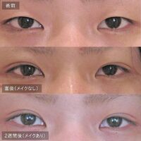 画像1446：LS法ダブル (ロングプラン)
