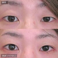 画像1449：LS法ダブル (ロングプラン)