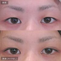 画像1452：LS法ダブル (ロングプラン)