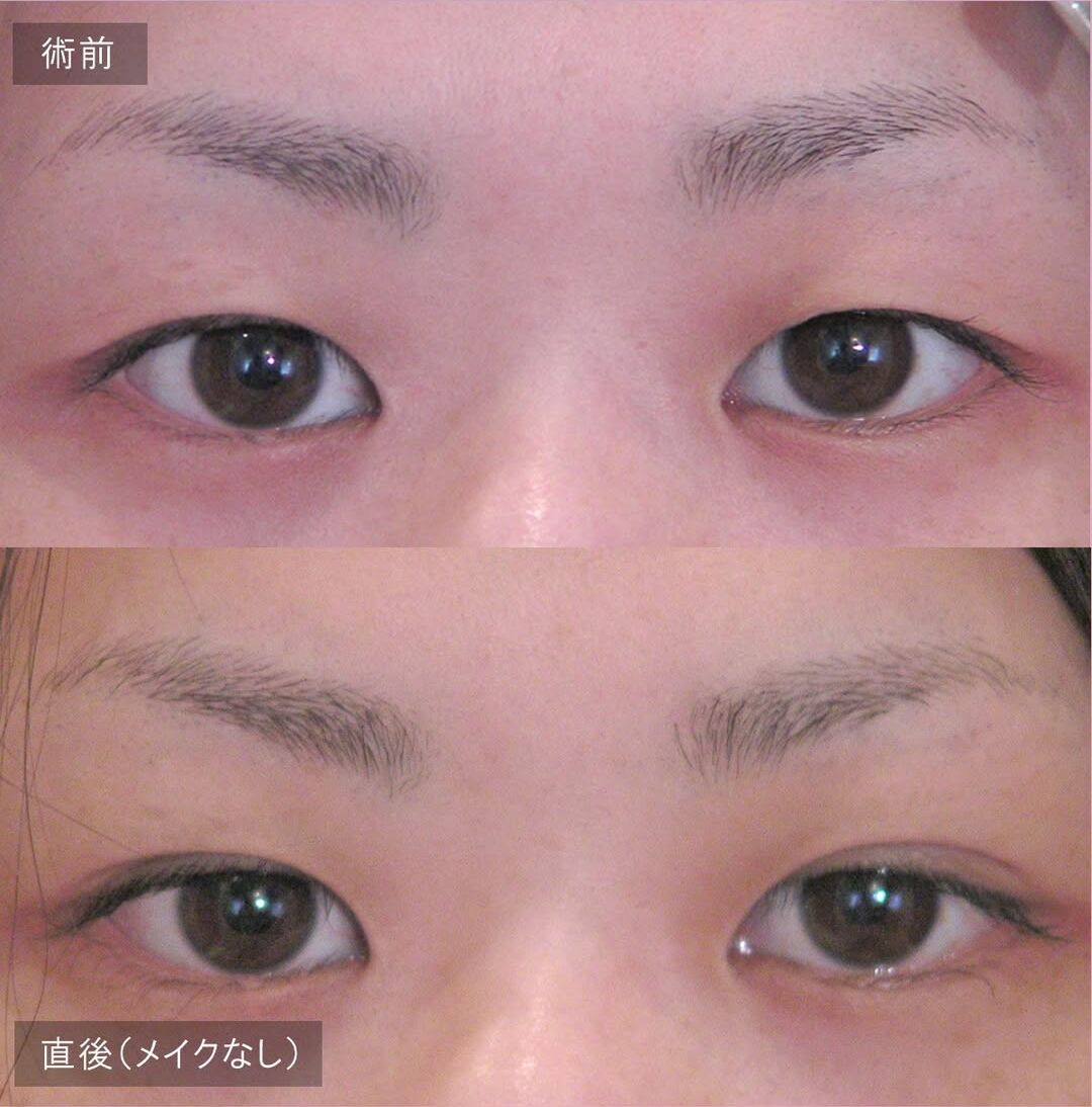 LS法ダブル(ロングプラン)