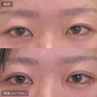 画像1455：LS法ダブル (ロングプラン)