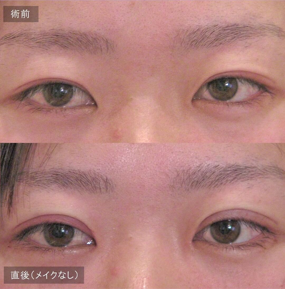 LS法シングル(ロングプラン)