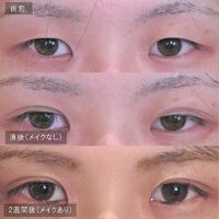 画像1458：LS法ダブル (ロングプラン)