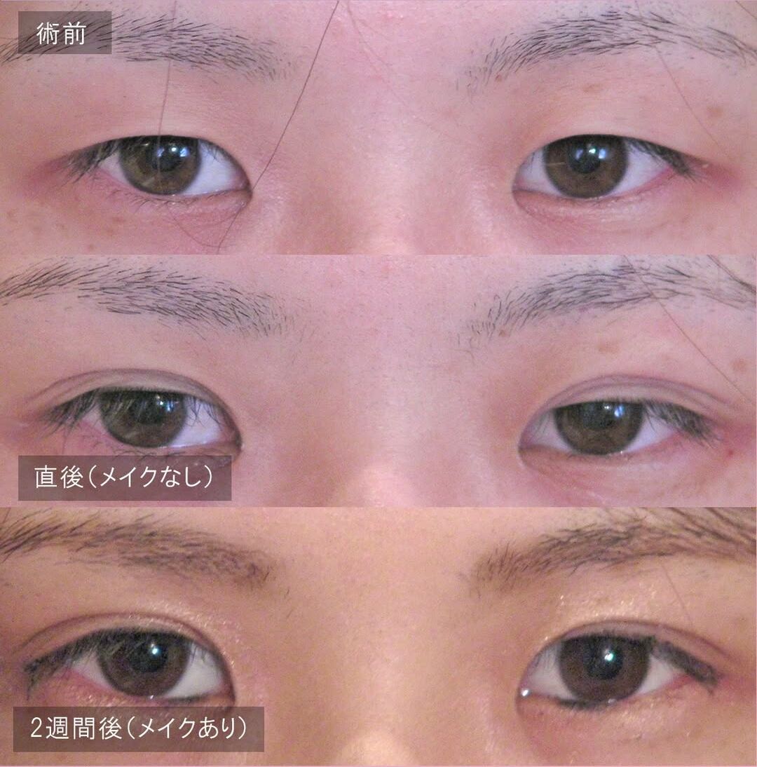 LS法ダブル(ロングプラン)