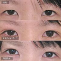 画像1612：LS法ダブル (ロングプラン)