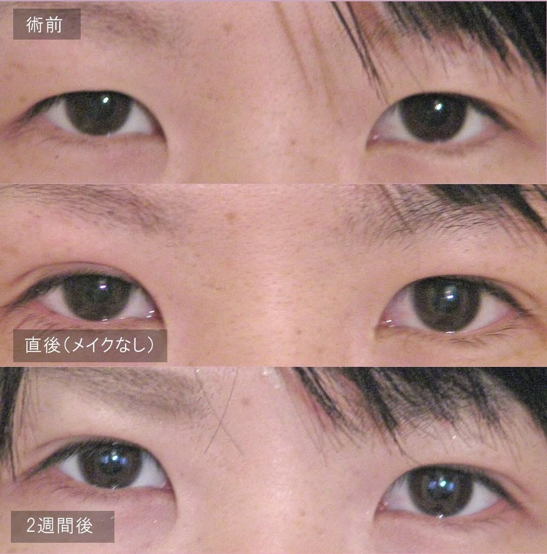 LS法シングル(ロングプラン)