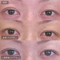 画像1615：LS法ダブル (ロングプラン)