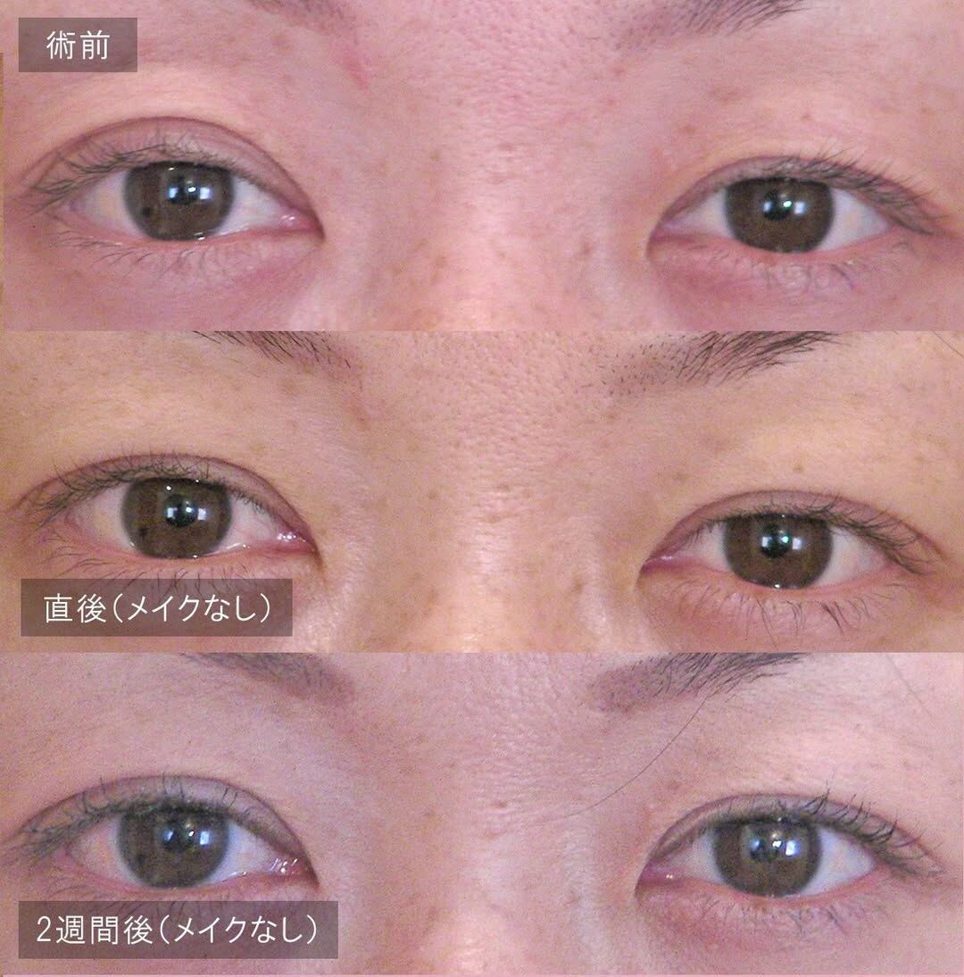 LS法ダブル(ロングプラン)