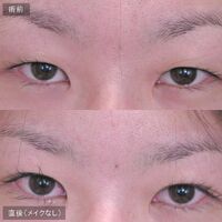 画像1618：LS法ダブル (ロングプラン)