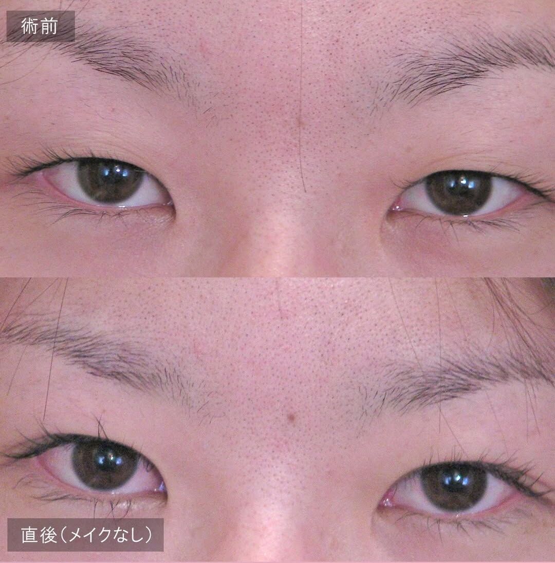 LS法ダブル(ロングプラン)