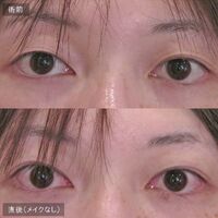 画像1621：LS法ダブル (ロングプラン)