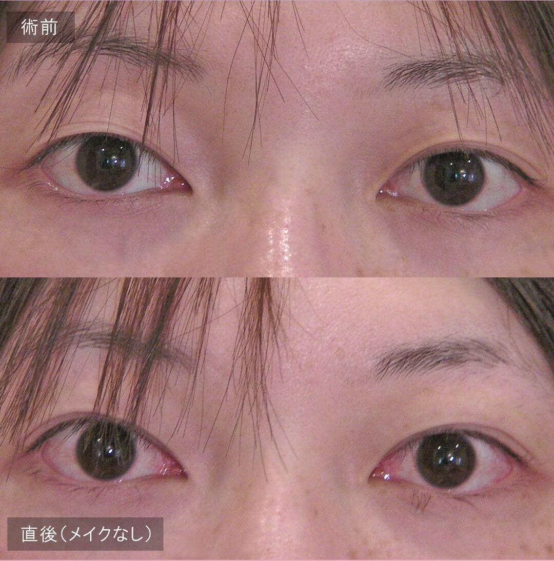 LS法ダブル(ロングプラン)