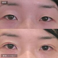 画像1624：LS法ダブル (ロングプラン)