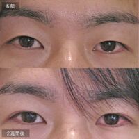 画像1627：LS法ダブル (ロングプラン)