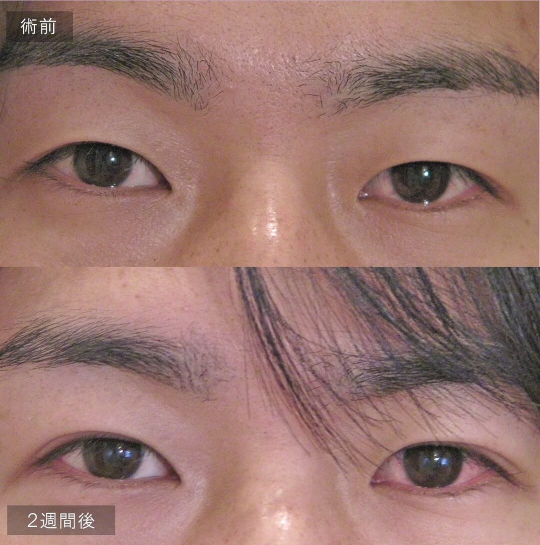 LS法ダブル(ロングプラン)＋目の上脂肪取り＋他院抜糸