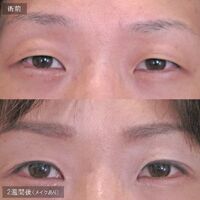 画像1636：LS法ダブル (ロングプラン)