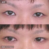 画像1639：LS法ダブル (ロングプラン)