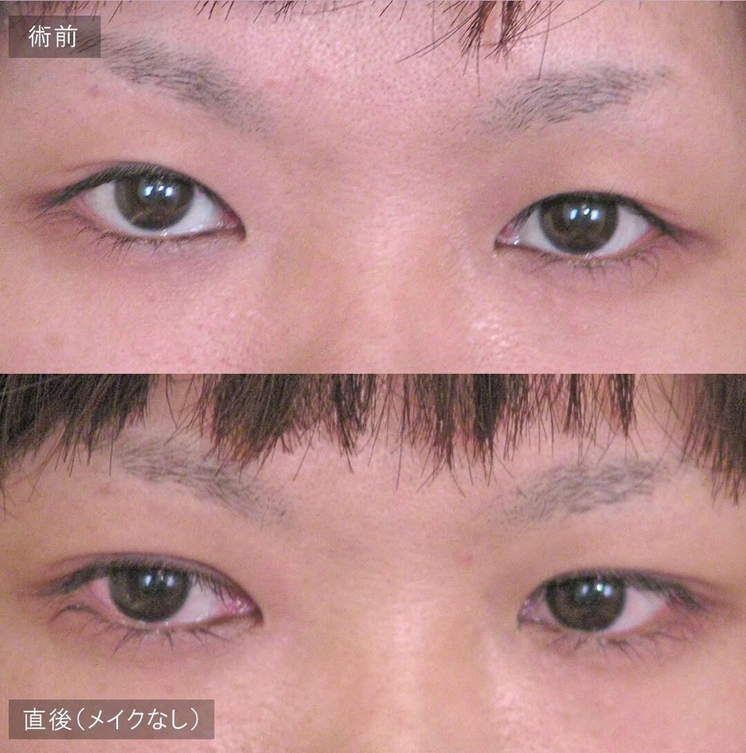 LS法シングル(ロングプラン)