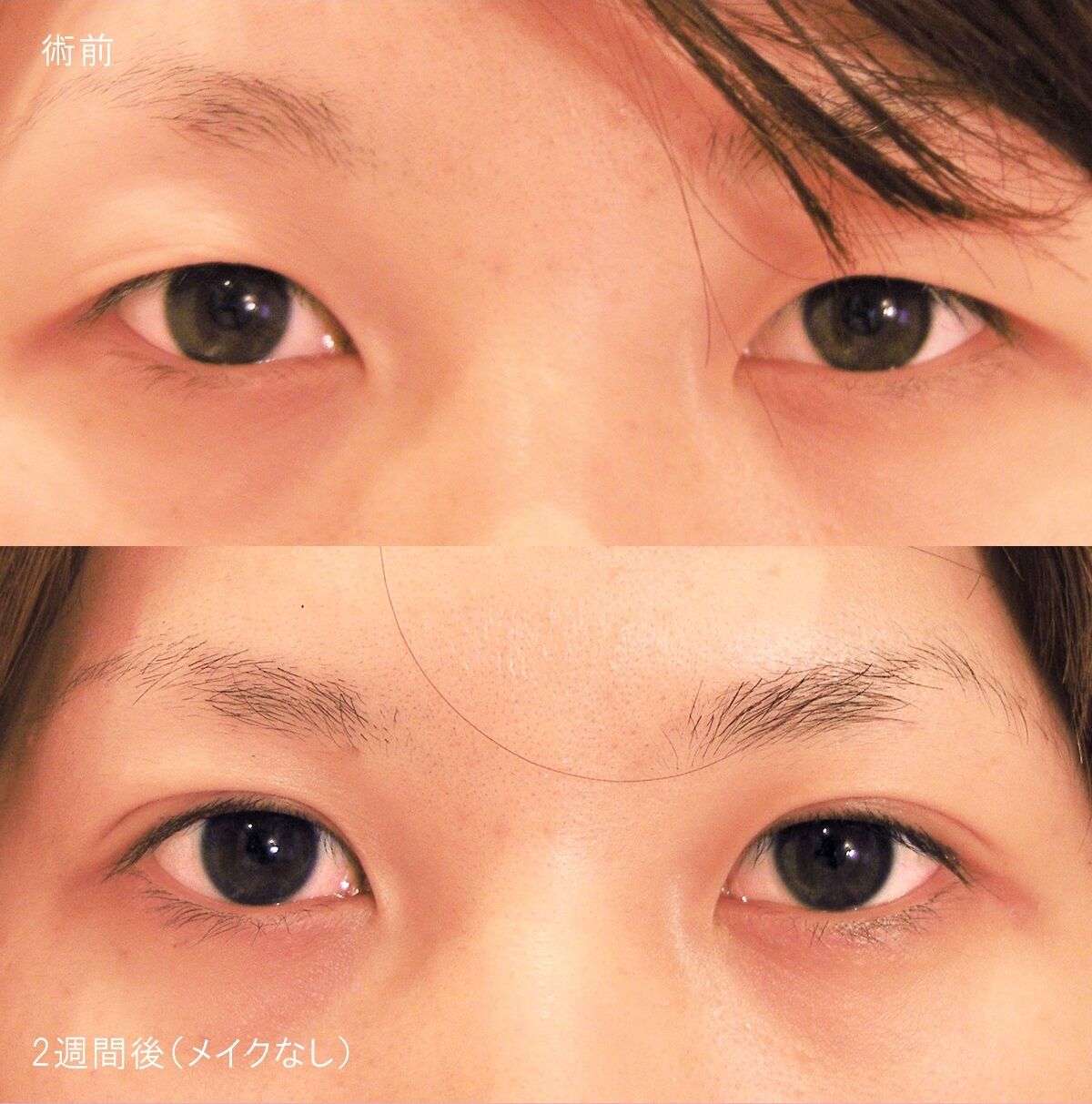 LS法ダブル(ロングプラン)