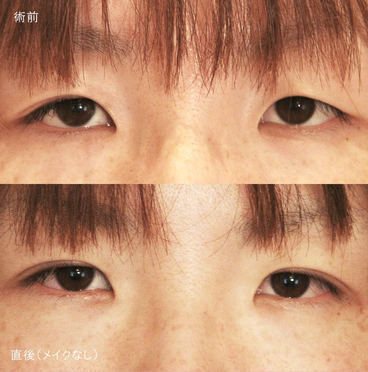 LS法ダブル(ロングプラン)