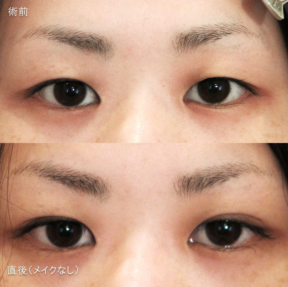 LS法ダブル(ロングプラン)
