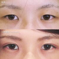 画像3196：LS法ダブル (ロングプラン)