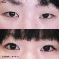 画像3205：LS法ダブル (ロングプラン)