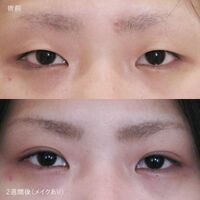 画像3948：LS法ダブル (ロングプラン)