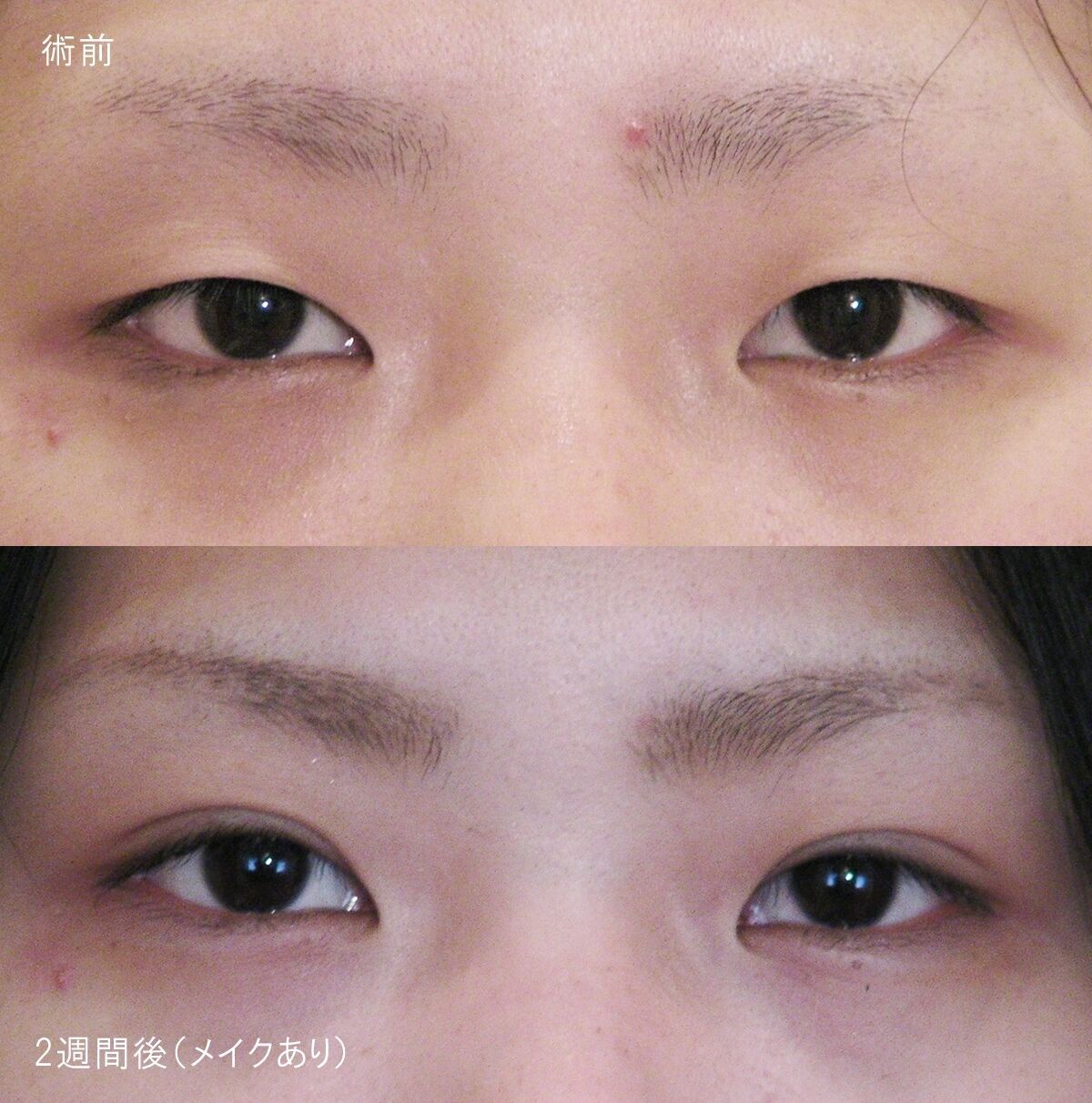 LS法シングル (ロングプラン)
