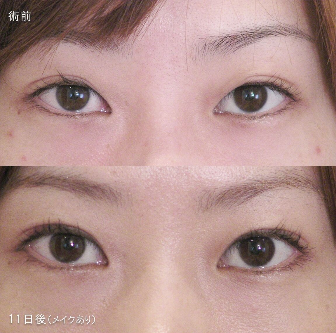 LS法ダブル (ロングプラン)