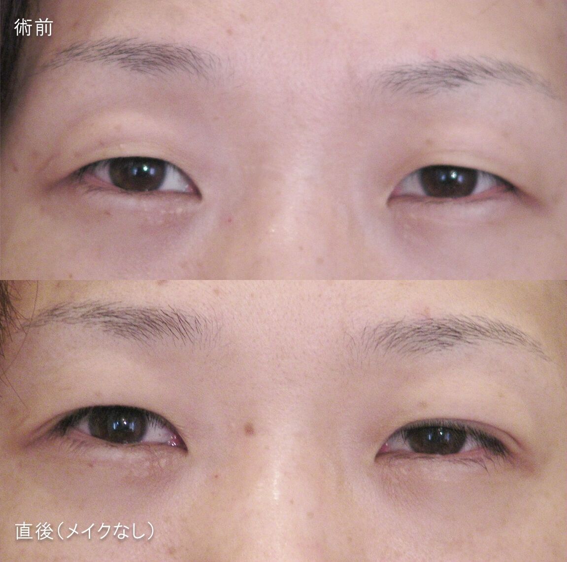 LS法ダブル (ロングプラン)