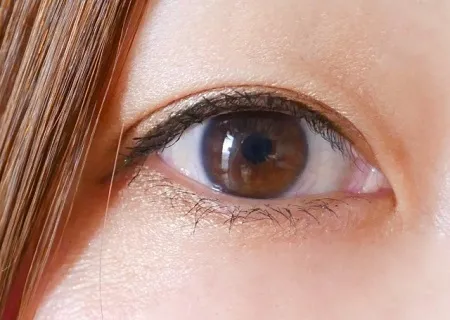 3.抜糸後の腫れ