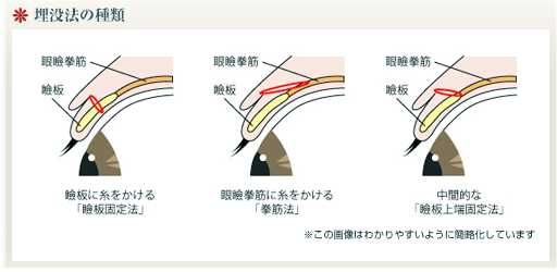 埋没法