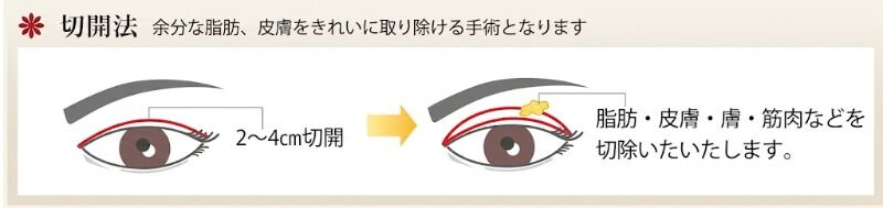 切開法